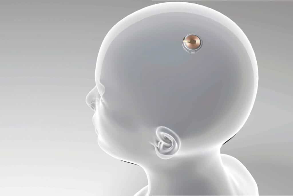 découvrez les principaux concurrents dans le domaine des implants cérébraux, leurs innovations technologiques et les avancées qui révolutionnent la neurotechnologie.